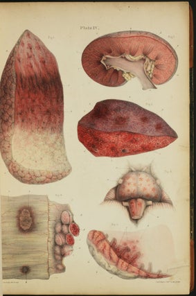 Item #325 Pathological Anatomy. Illustrations of the Elementary Forms of Diseases. Robert Carswell
